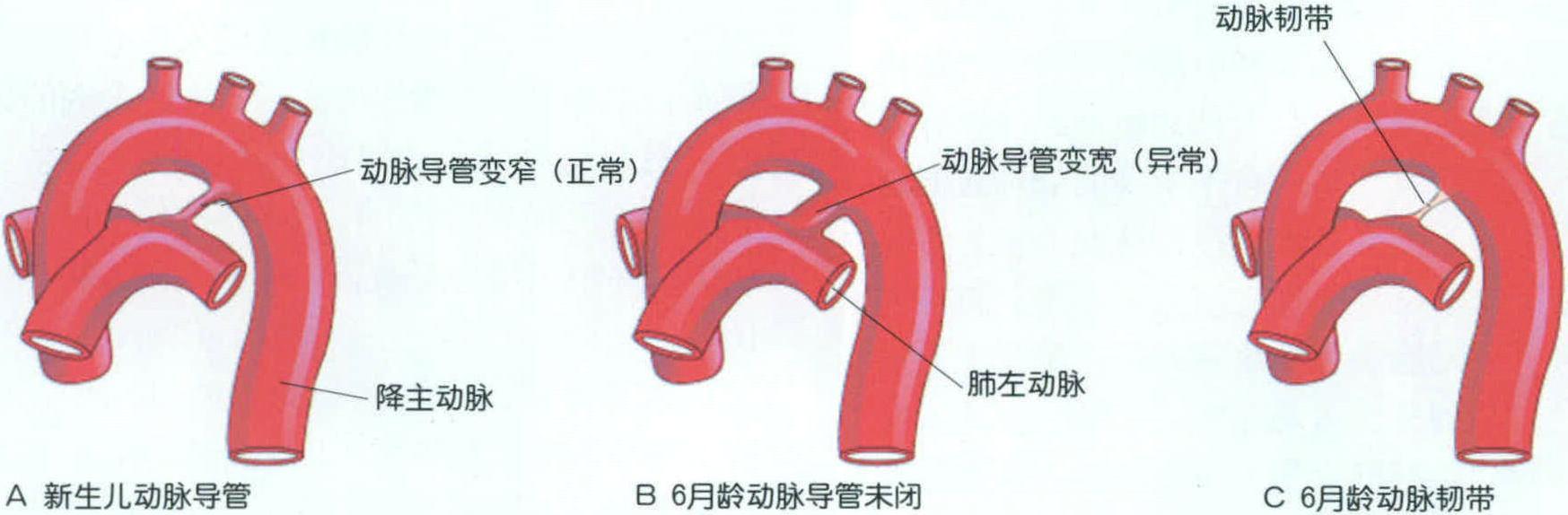 血管变异和畸形